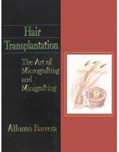 Hair Transplantation: The Art of Micrografting and Minigrafting