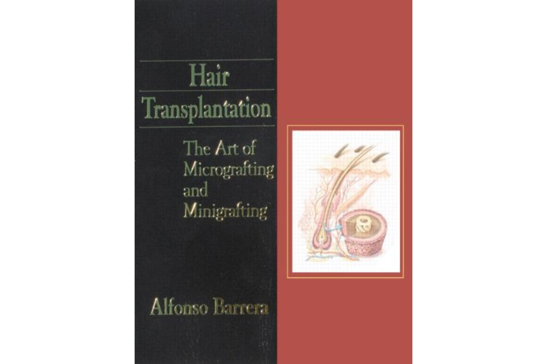 Hair Transplantation: The Art of Micrografting and Minigrafting
